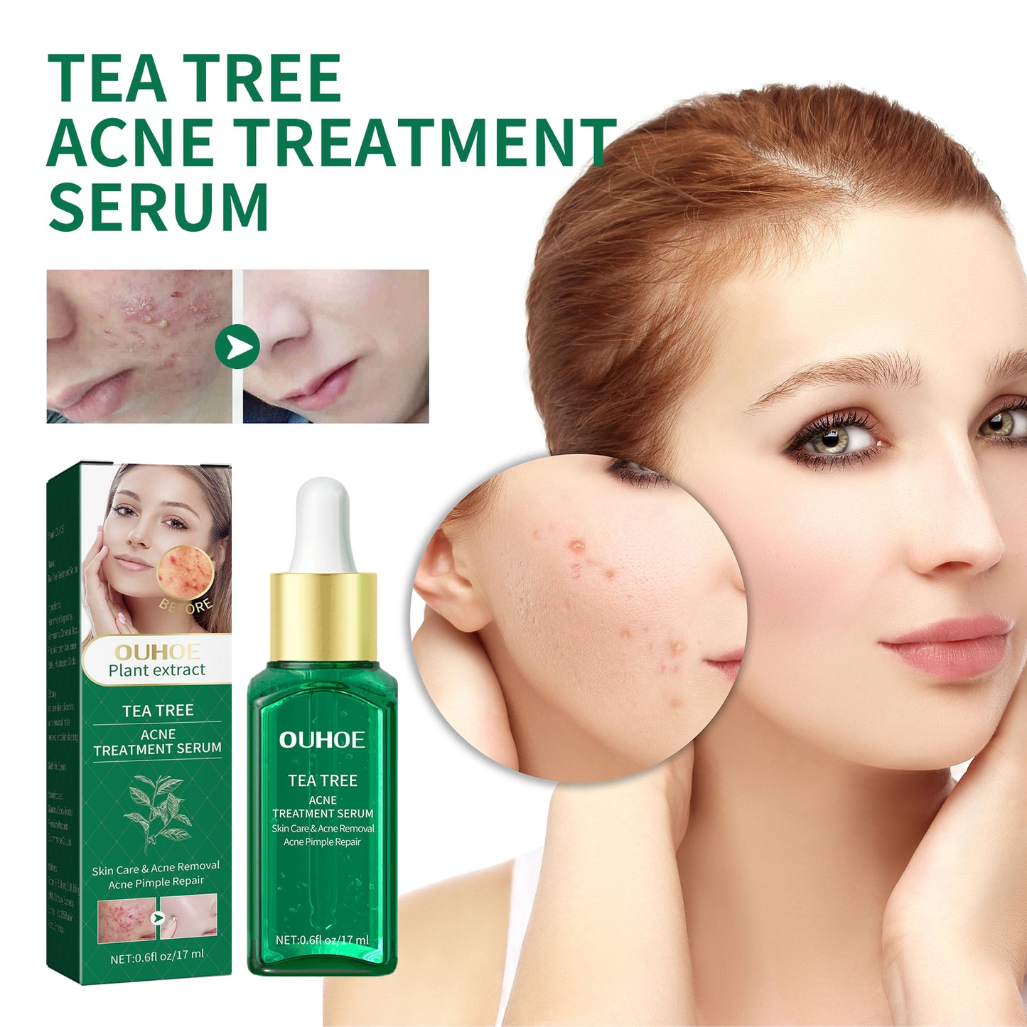 GlowVital™ Tea Tree Acne Repair Serum